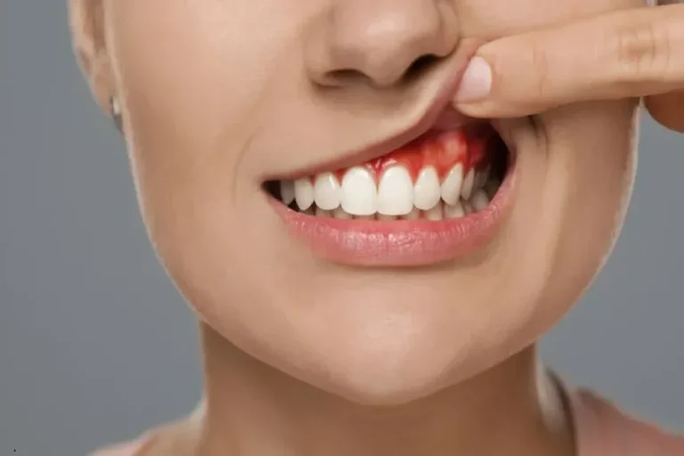 Caring For Your Gums After Periodontal Treatment