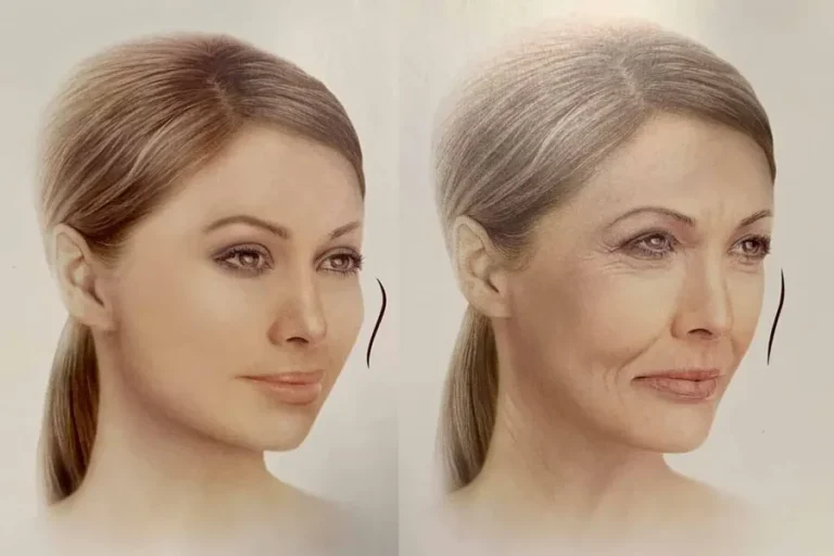 Cheek Augmentation Fillers: Transform Your Look with Natural Volume