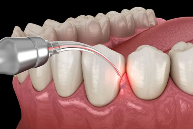 How Bone Grafting Supports Successful Dental Implants