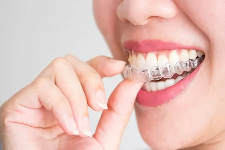 Invisalign And Cosmetic Dentistry: A Seamless Blend For Smile Perfection