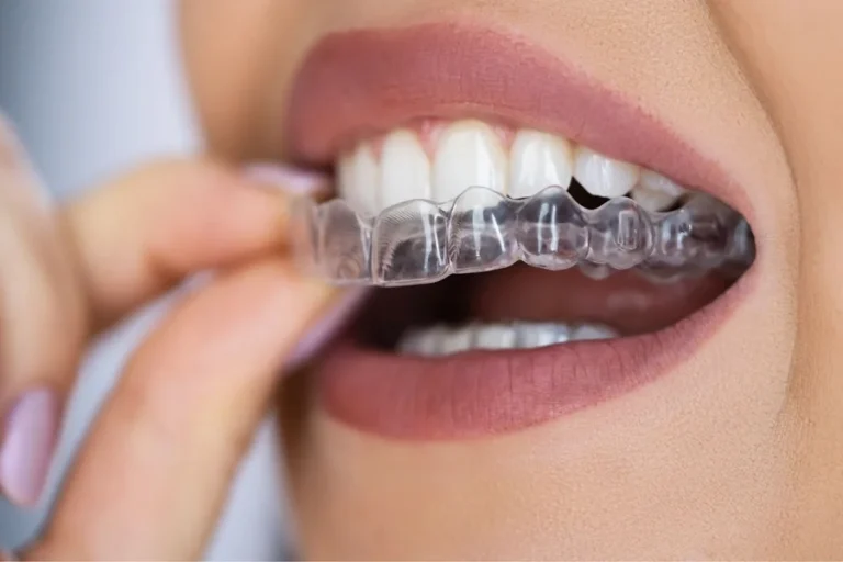 5 Common Myths About Braces And Aligners Debunked