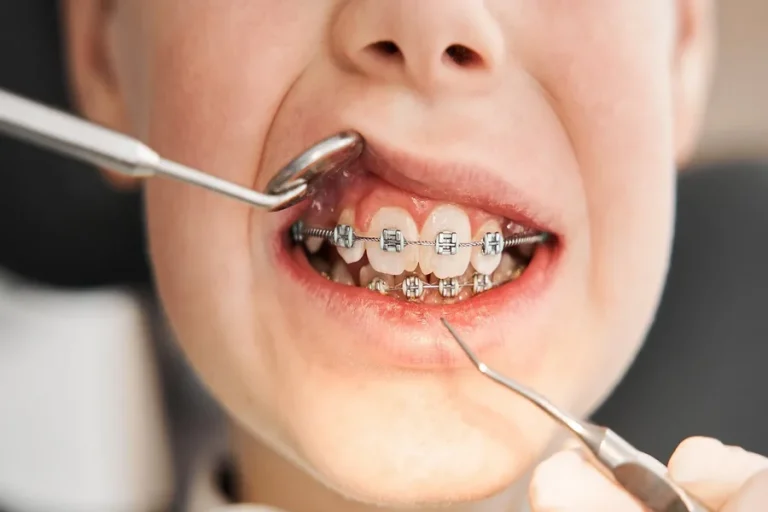 The Role Of Gum Health In Successful Orthodontic Treatment