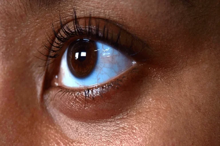 Dark Eye Circles Filler | Top Reasons Why It’s Popular