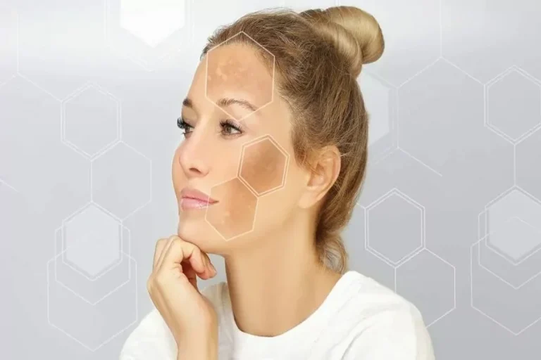 Understanding Facial Pigmentation and Why It Happens