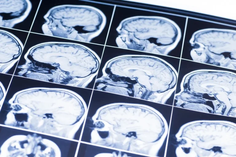 What Makes Brain Injury Cases in Dallas, TX, Harder to Handle